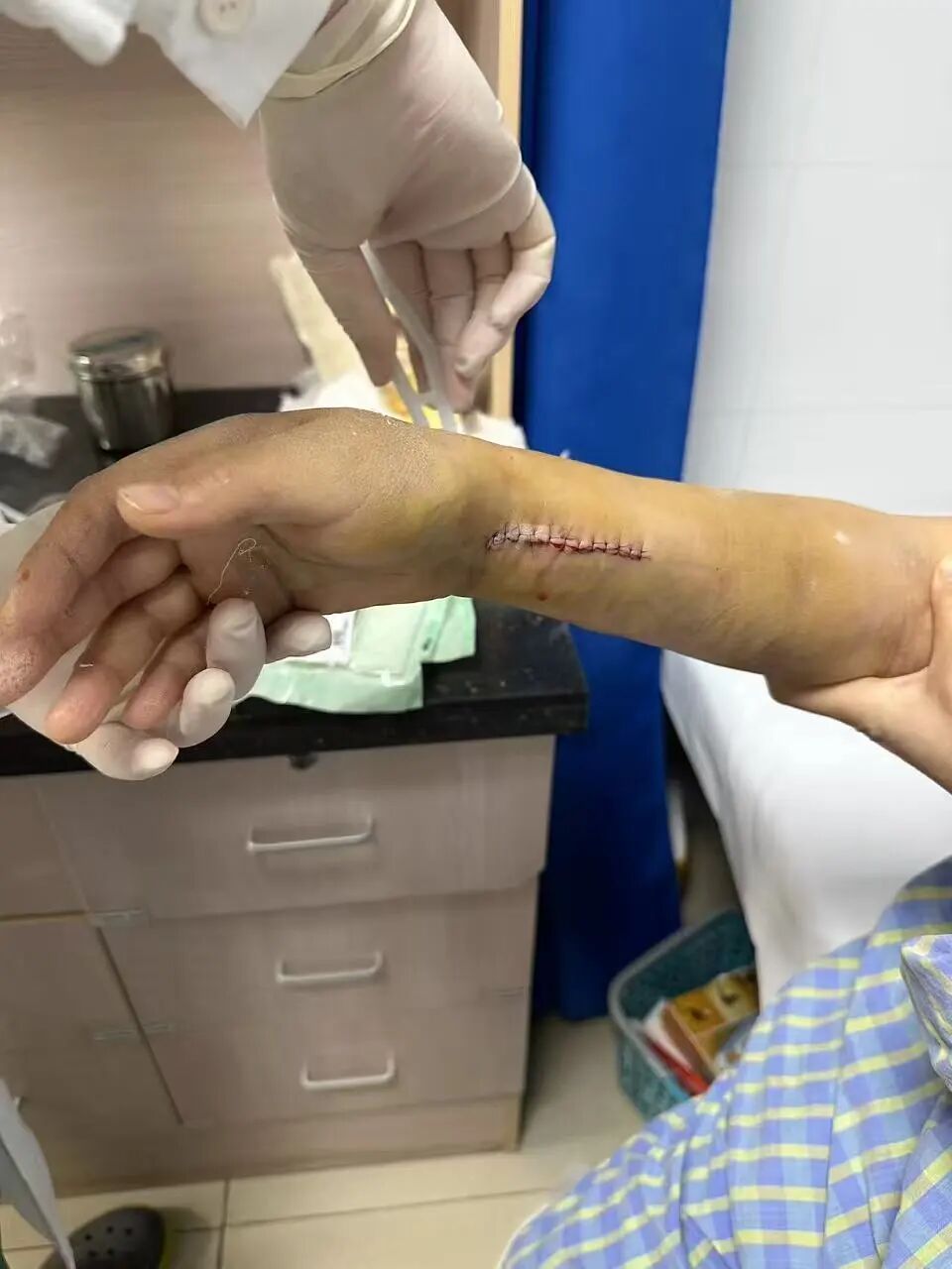 事发陆家嘴天桥！上海阿姨摔惨了，桡骨骨折，缝了26针！网友：下雨天这里总有人滑倒