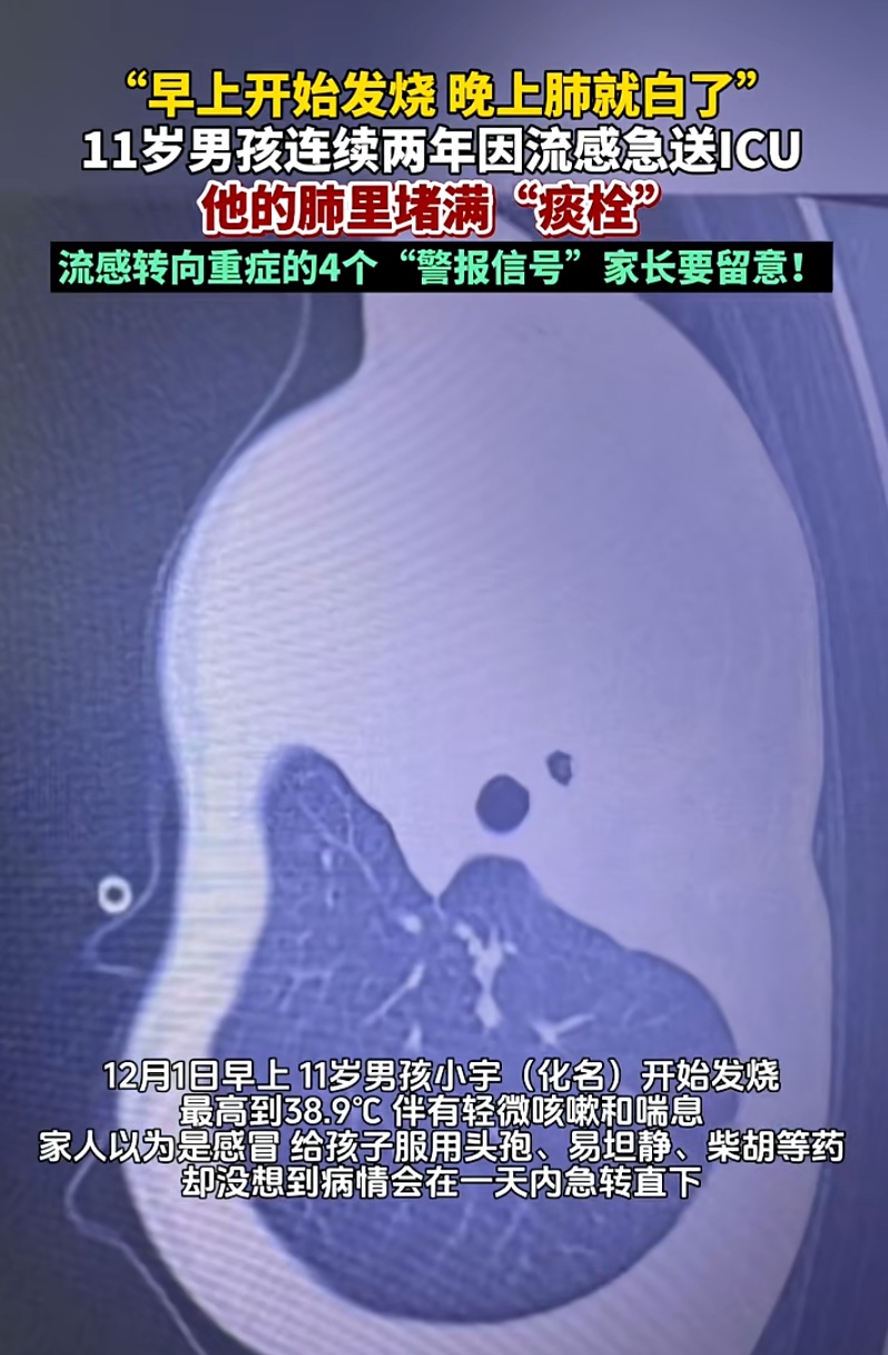 发热一天就病危！11岁男孩肺里长出“死亡树杈”