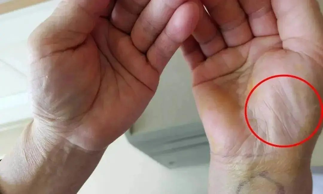 手上出现这些症状，是疾病来袭