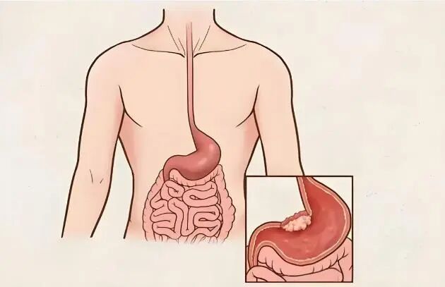 八旬老人腹部日渐隆起，竟是体内藏了个直径25厘米的“定时炸弹”