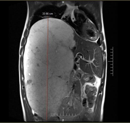 男子腹中竟长出3.7公斤“定时炸弹”！专家手术6小时，“切除是挽救其生命的唯一选择”