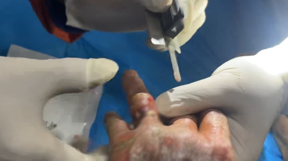 嵌入皮肉！女子的四镯一戒“逼停”救治