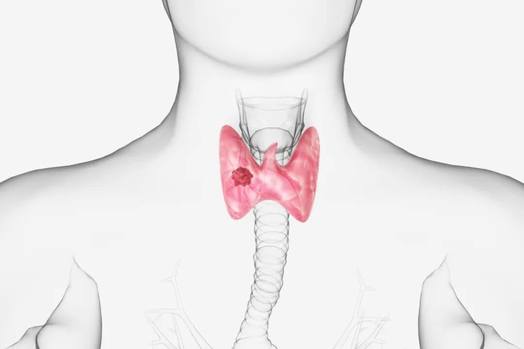 体检查出甲状腺结节，有必要做穿刺活检吗？