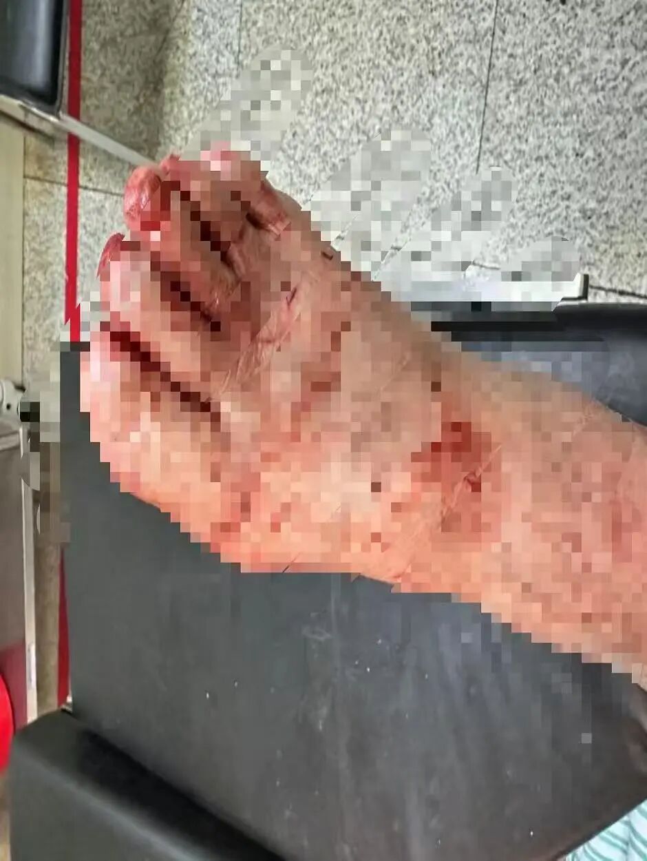 冬季高发！一声巨响突然炸了！杭州医院一晚上接诊两例......“血肉模糊”