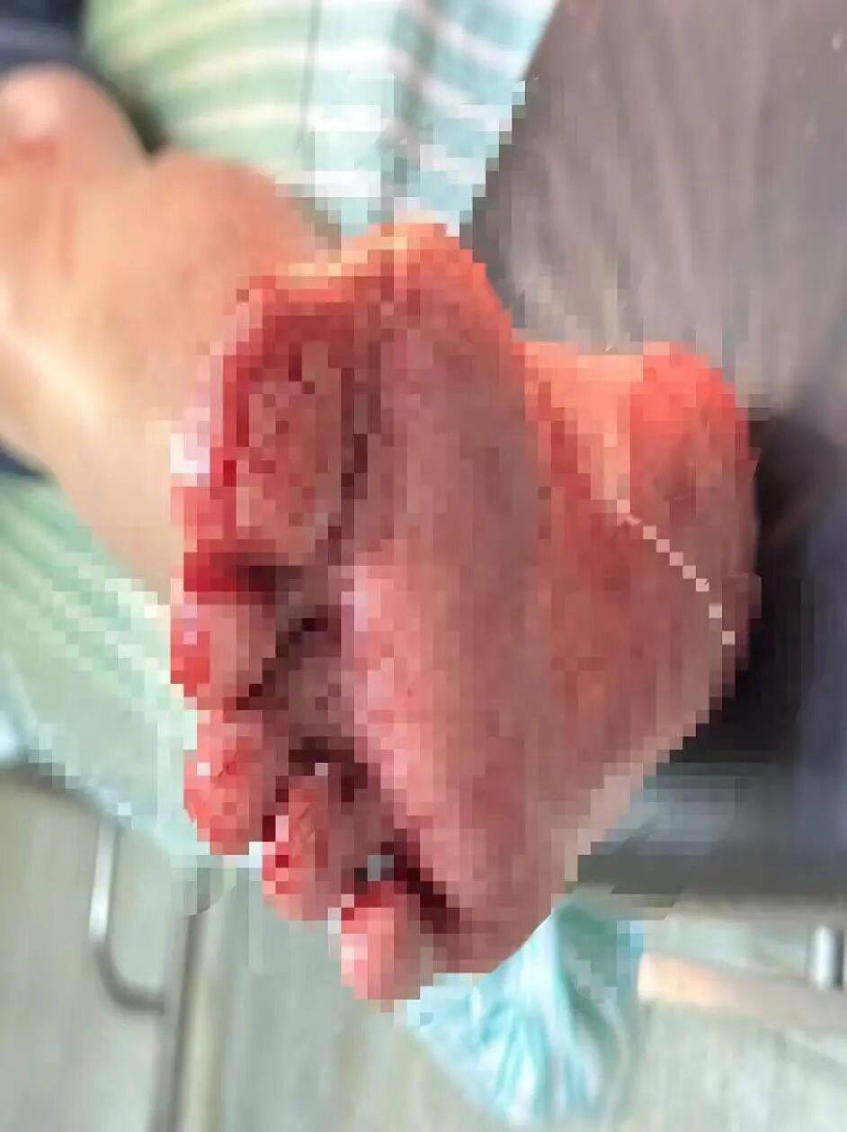 冬季高发！一声巨响突然炸了！杭州医院一晚上接诊两例......“血肉模糊”