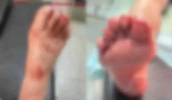 突然炸了！洗澡时一声巨响， 9岁女孩多处受伤！不少家庭都有，近期多发…