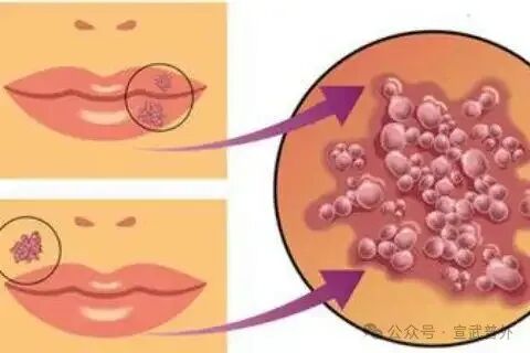 嘴角小水泡竟会传染病毒！