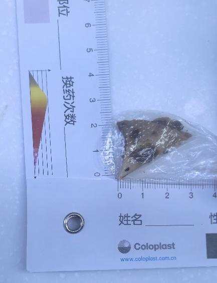 猪骨头卡喉，男子强吞饭团“疏通”导致食管破裂！医生提醒这些方法别再用了