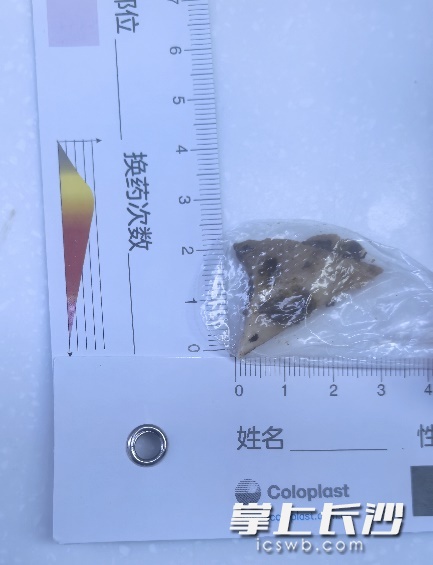 长沙男子碎骨卡喉，用饭团强吞被划破食管！医生紧急提醒