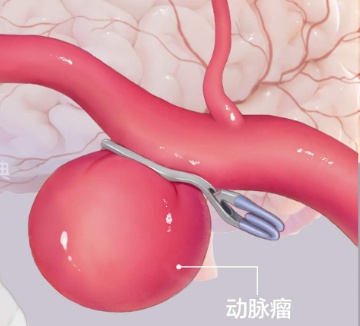 不是所有头痛都能忍，冬季这类疼痛要特别当心！