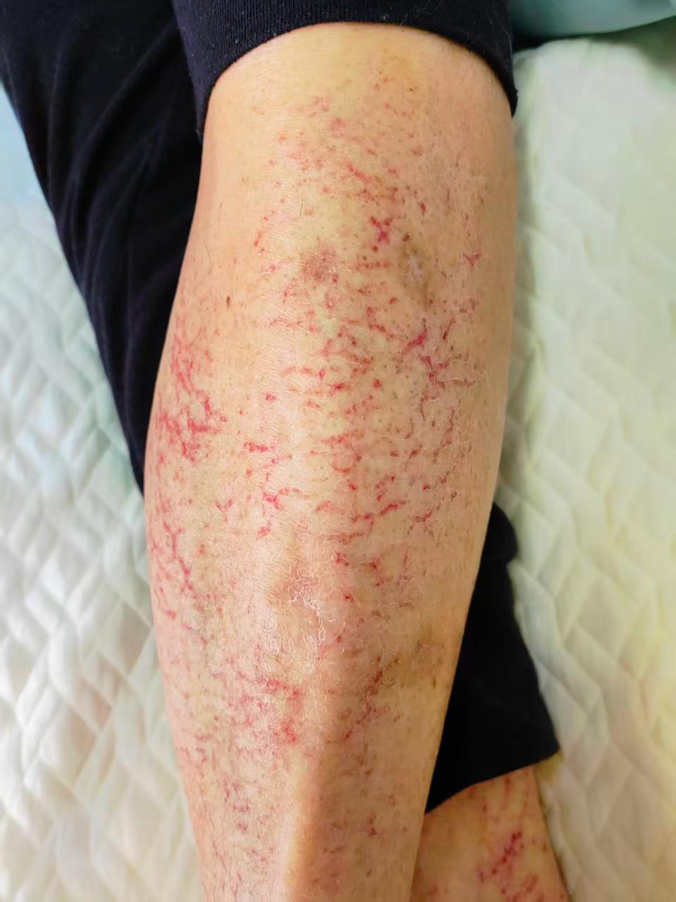 连续3天在电暖麻将桌上打麻将，女子小腿长出暗红色斑纹