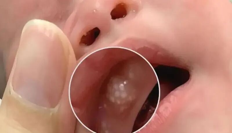 2个月宝宝被奶奶擦碘伏进了ICU