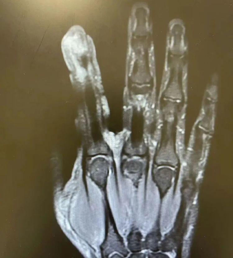 扯下倒刺后,浙江男子差点没命!医生提醒:这不是小事儿,千万别手欠 扯下倒刺后,浙江男子差点没命!医生提醒:这不是小事儿,千万别手欠