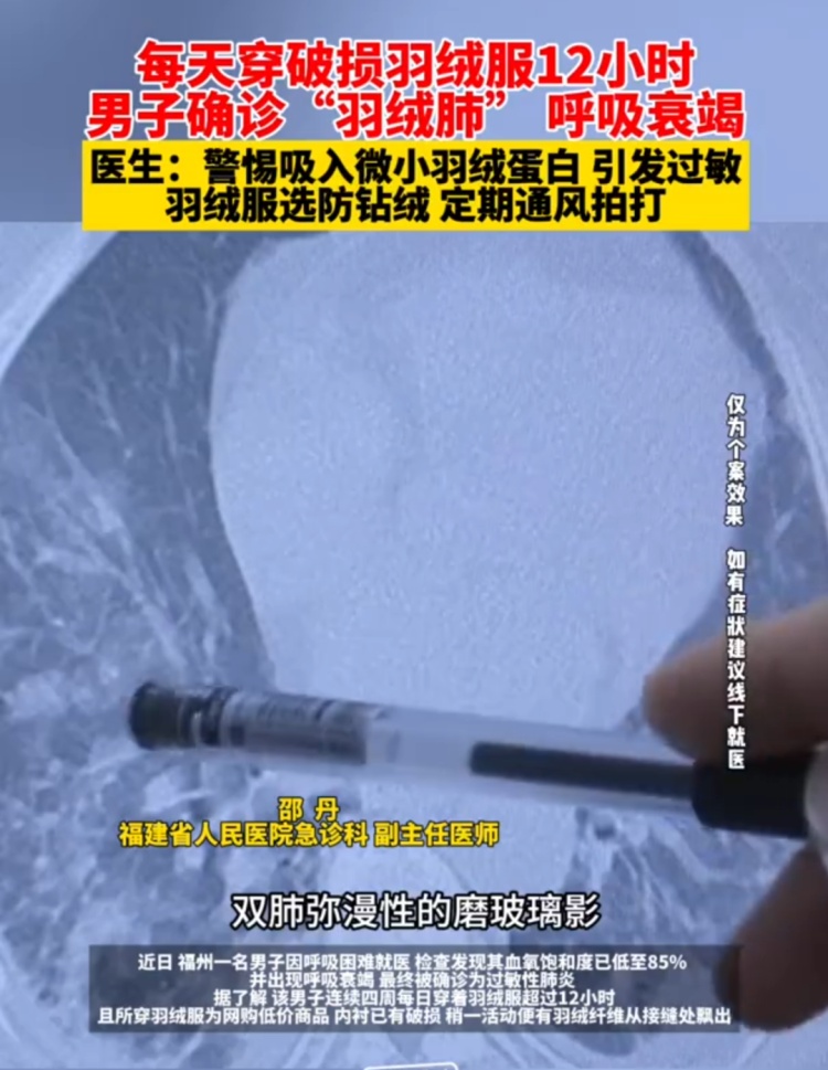 羽绒服“漏绒”致呼吸衰竭！医生：警惕“羽绒肺”