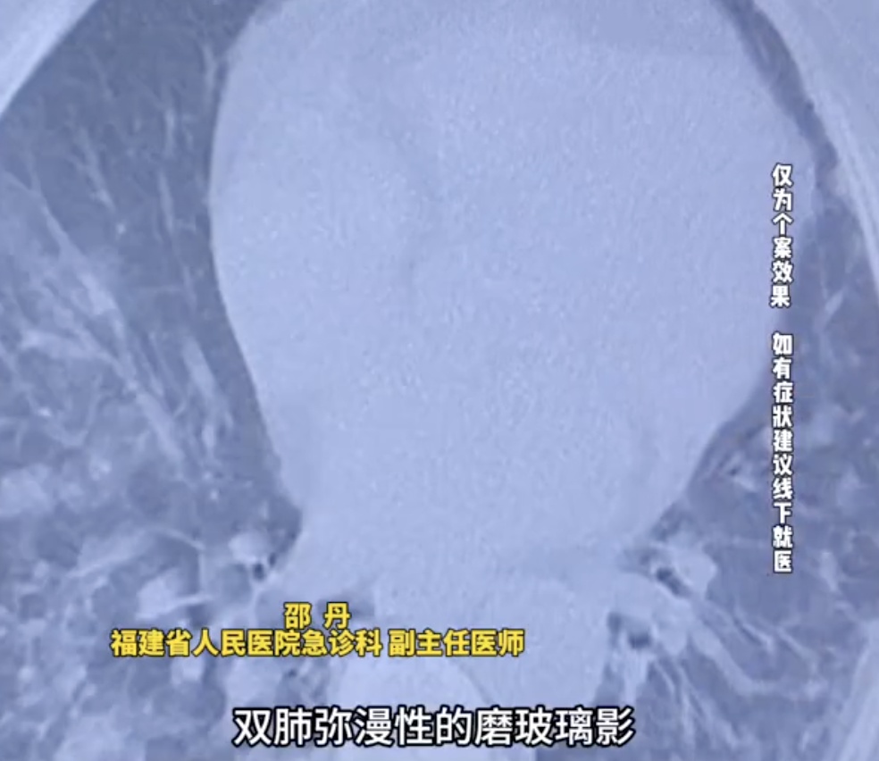 每天穿羽绒服超12小时,确诊“羽绒肺”,呼吸衰竭 每天穿羽绒服超12小时,确诊“羽绒肺”,呼吸衰竭