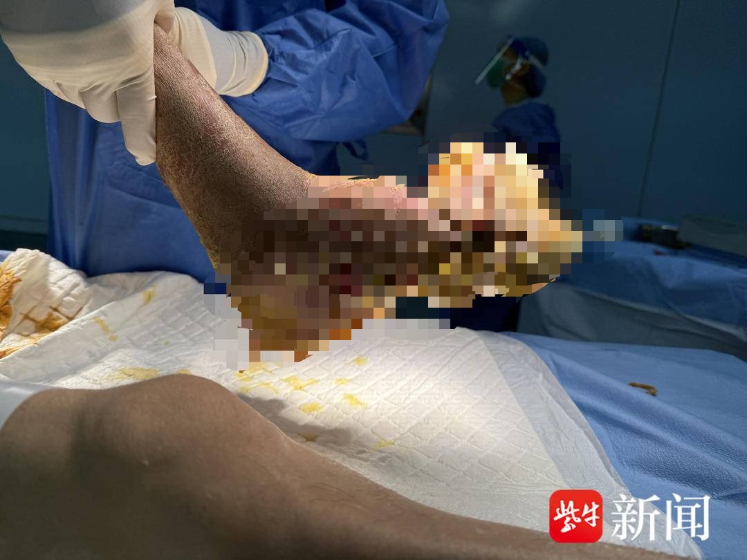 男子抠脚“抠”出满脚“菜花”，肛周也有少量，最终确诊HPV