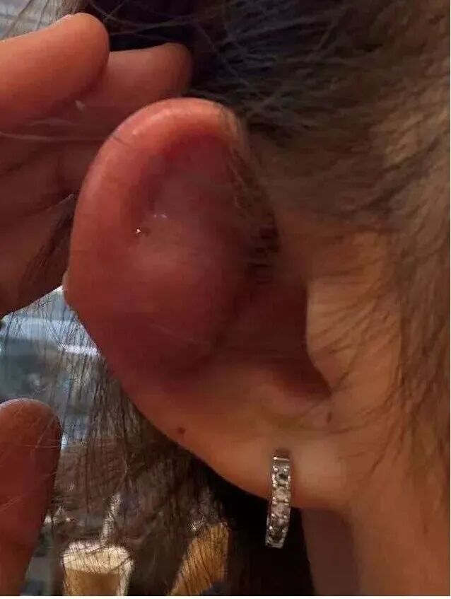 吓人！浙江姑娘耳朵险些丢了！只因干了这件事