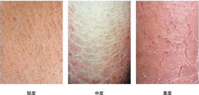 不少广东人烦恼：最近一钻被窝就浑身痒？