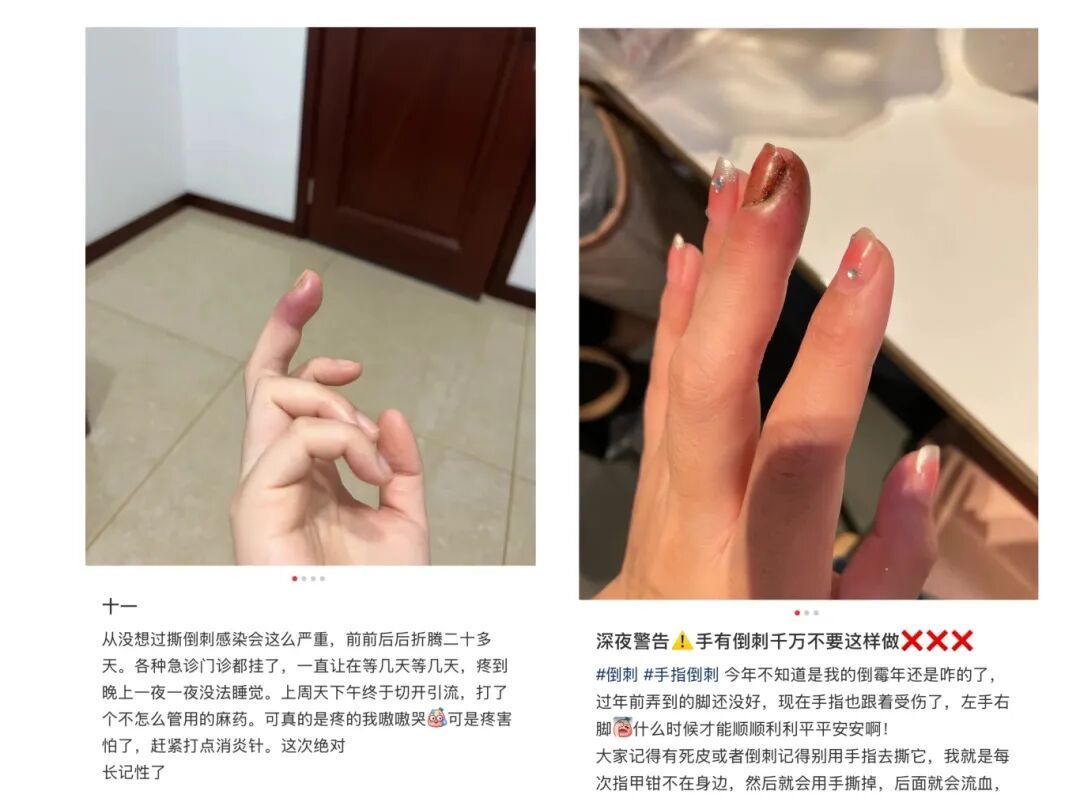 不要拔！不要拔！有人因此进急诊、拔甲、截肢！