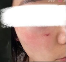 快自查！女子差点因为它破相，这东西很多人喜欢