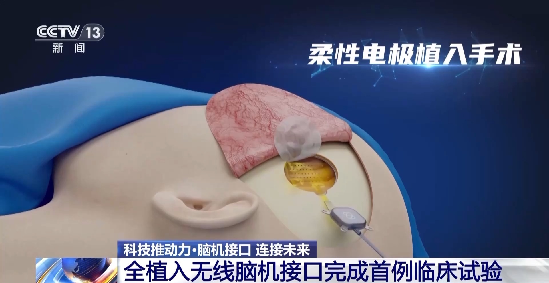 当脑机接口走进生活,会为我们带来哪些新可能? 当脑机接口走进生活,会为我们带来哪些新可能?