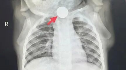 一岁宝宝突然性情大变，厌食一周！上海医生检查后发现竟是这个原因