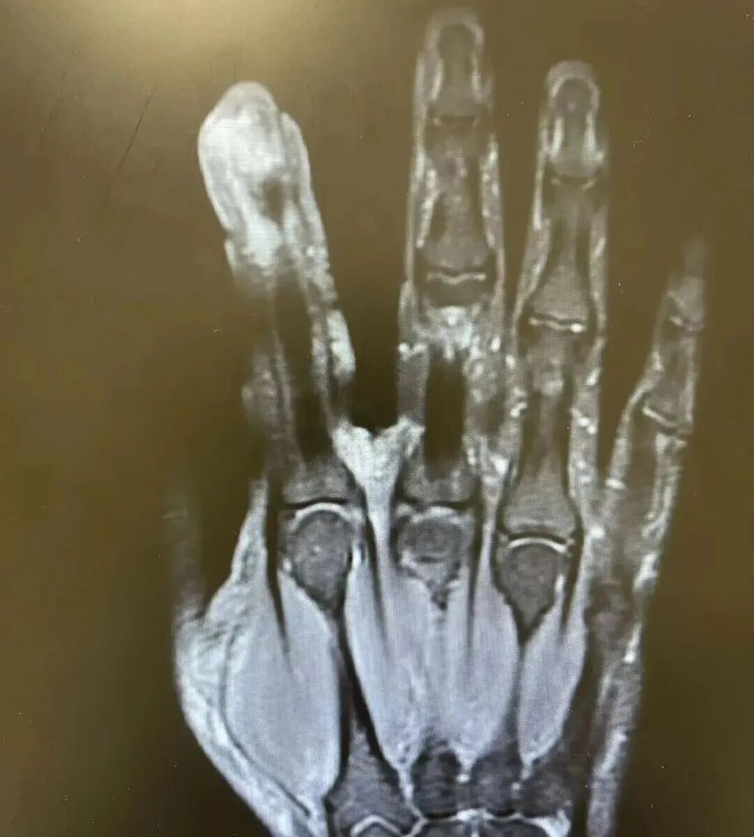 不要拔,很多人忍不住!杭州男子不慎感染导致溃烂、刮骨疗毒 不要拔,很多人忍不住!杭州男子不慎感染导致溃烂、刮骨疗毒