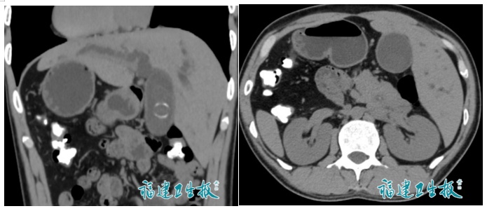 罕见!福建发现1例“镜面人”,“全球仅百万分之一”,更棘手的是…… 罕见!福建发现1例“镜面人”,“全球仅百万分之一”,更棘手的是……