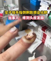 不要拔，很多人忍不住！42岁男子感染致溃烂、骨肉坏死，知名女星曾因此入院手术