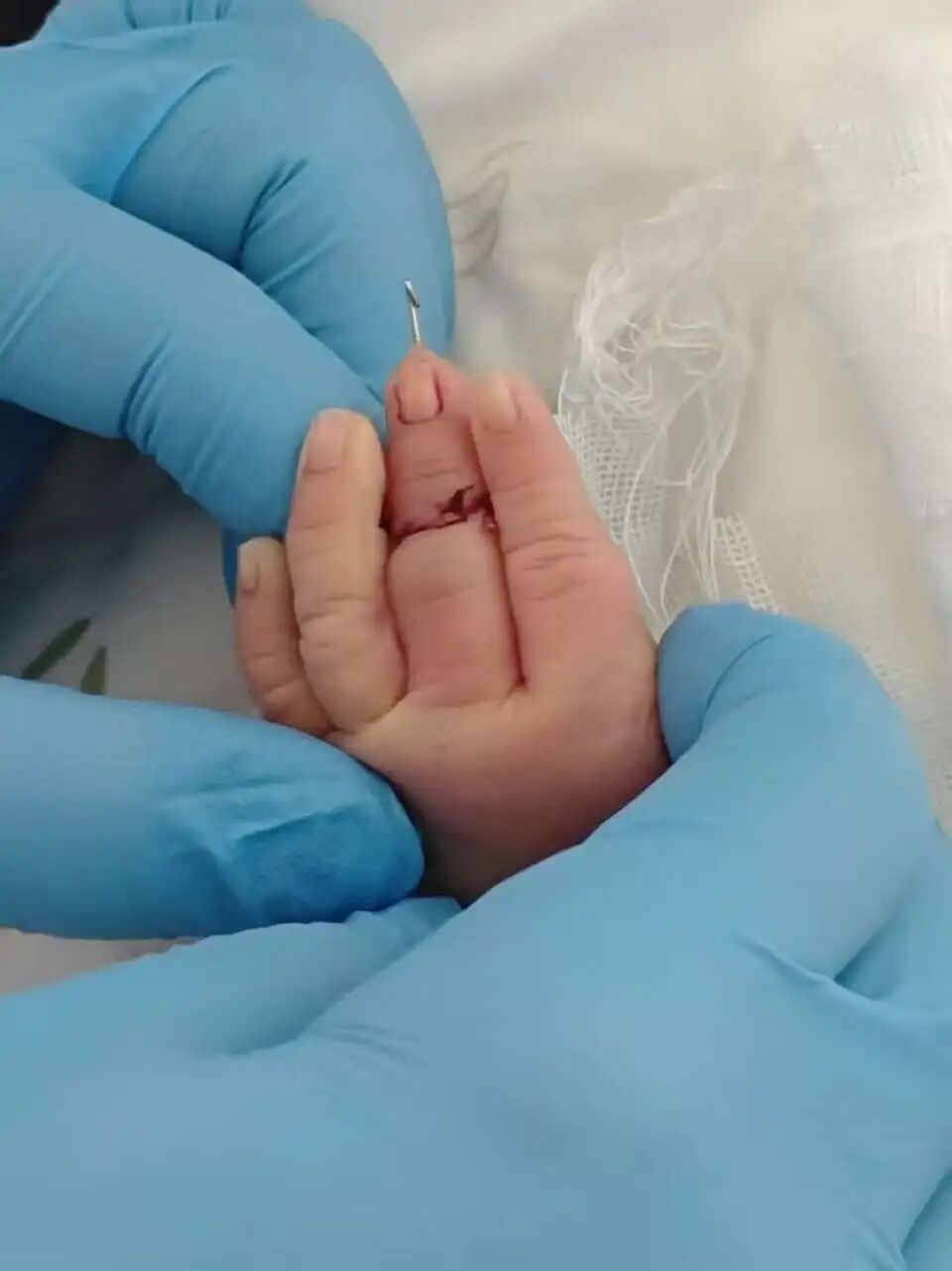 江苏一新生儿手指在剖宫产手术中被切断，官方通报：系助产士操作严重失误，已被停职
