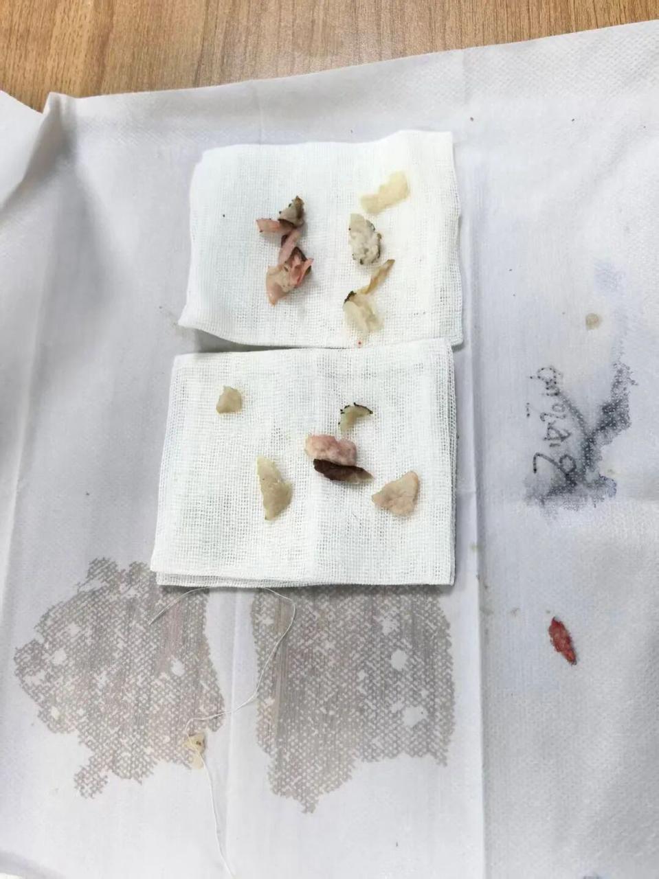 男子酒后昏迷，送医时面色瞬间青紫且心脏骤停！医生从他气道中取出数块肉片……