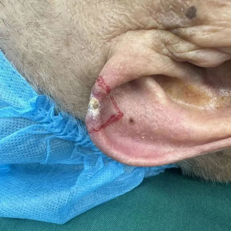 耳朵上的“小疙瘩”，扩散到了腿上！一查竟是癌……医生：这种癌趋于年轻化