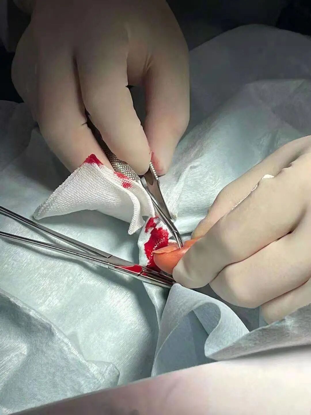 不要拔，很多人忍不住！42岁男子感染致溃烂、骨肉坏死，知名女星曾因此入院手术