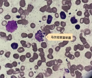 好好的人，突然高烧近40℃，肺都“烂穿”！医生：这样做有极大风险