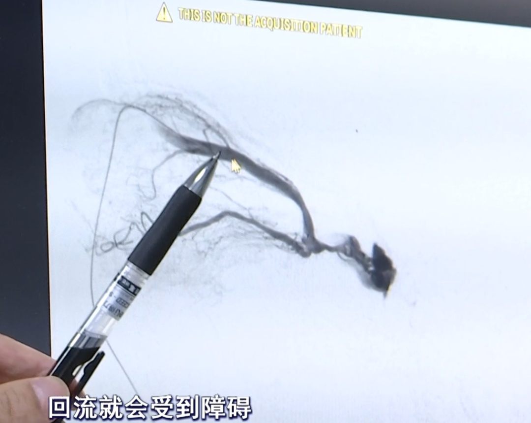 警惕！“红眼病”久治不愈？元凶可能藏在脑子里