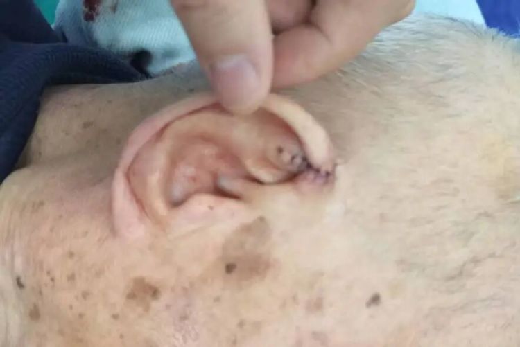 耳朵上的“小疙瘩”，扩散到了腿上！一查竟是癌……医生：这种癌趋于年轻化