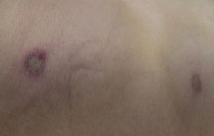 广西夫妻劳作时妻遭马蜂袭击1死1伤，妻子换掉体内八成“问题血液”惊险获救