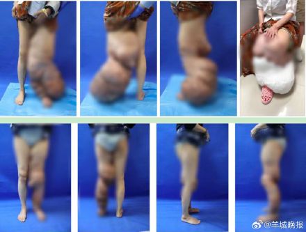 15 年 “大象腿” 煎熬，从每天贴100个创可贴到绝望求截肢，她终于等到希望！