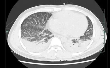 吃竹鼠进补,男子竟惹上"致命"真菌…… 吃竹鼠进补,男子竟惹上"致命"真菌……
