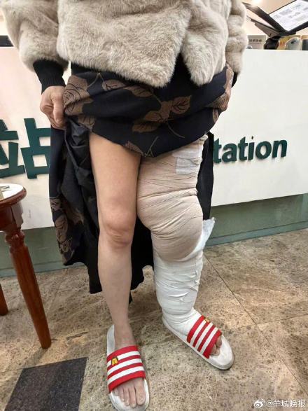 15 年 “大象腿” 煎熬，从每天贴100个创可贴到绝望求截肢，她终于等到希望！