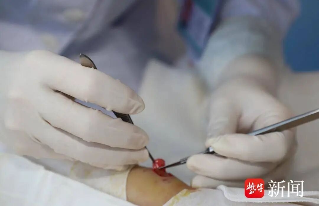 21岁女子连贴几晚暖宝宝入睡，致三度烫伤，专家：需手术清创