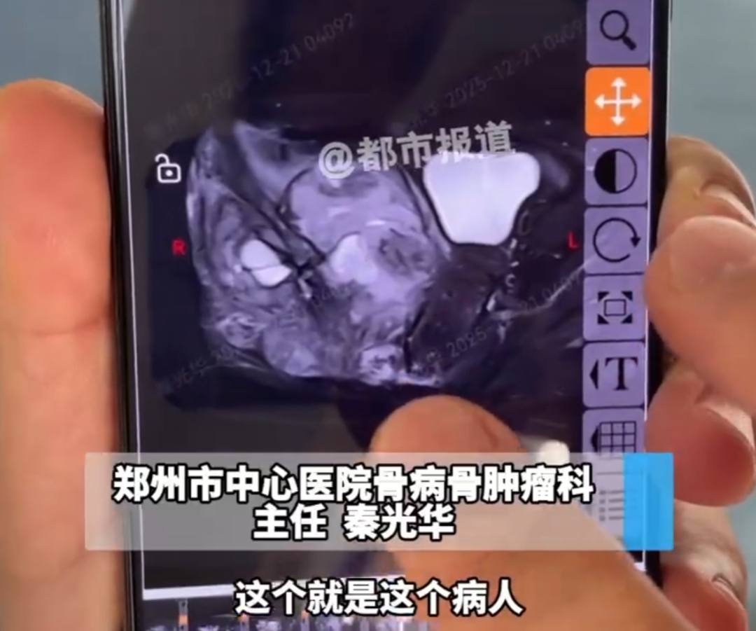 13岁女孩频繁屁股疼确诊骨癌！