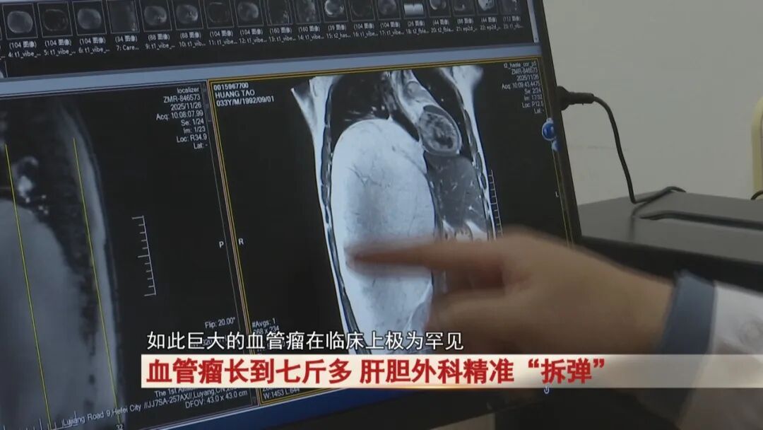 吓人！肚子痛忍忍就过？他拖到腹腔长出7斤“巨瘤”，医生6小时惊险“拆弹”