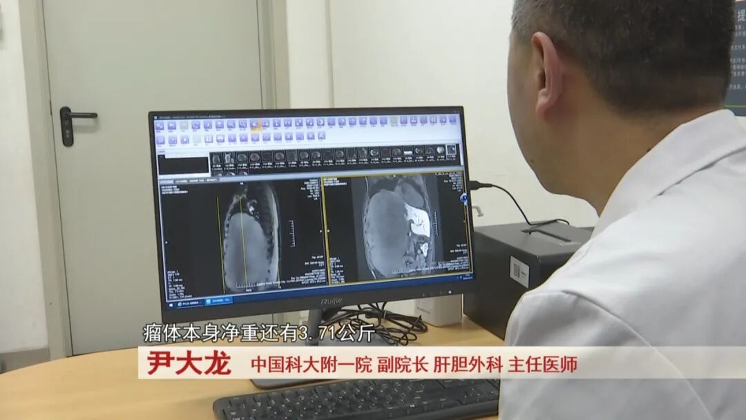 吓人！肚子痛忍忍就过？他拖到腹腔长出7斤“巨瘤”，医生6小时惊险“拆弹”