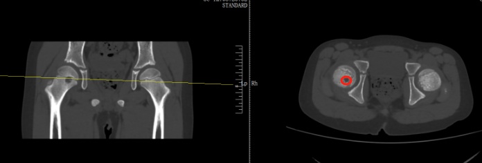13岁女孩频繁屁股疼确诊骨癌！