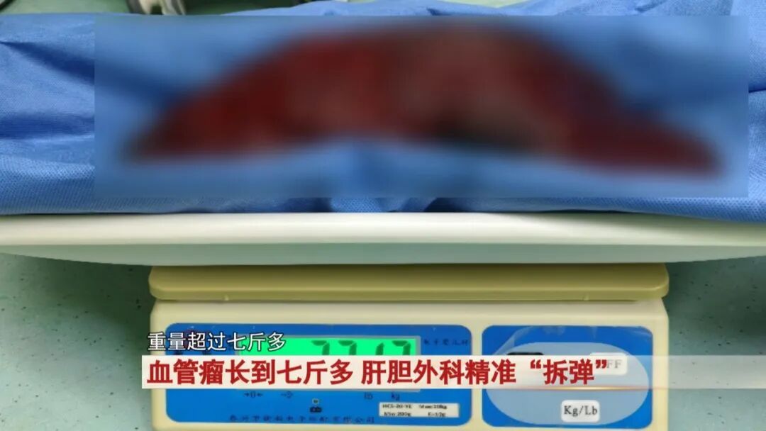 吓人！肚子痛忍忍就过？他拖到腹腔长出7斤“巨瘤”，医生6小时惊险“拆弹”
