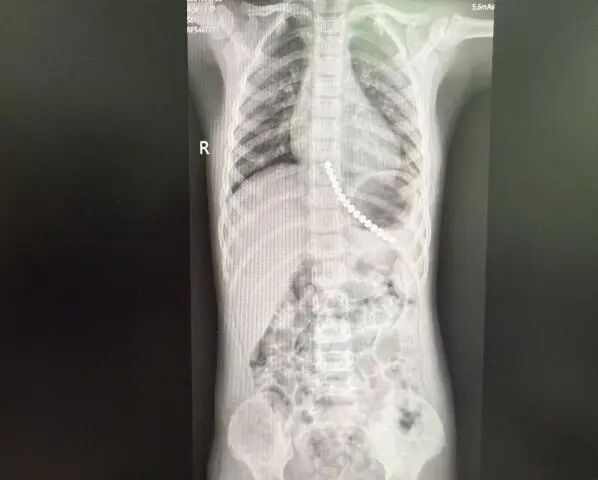 安徽3岁幼童紧急就医!医生:很危险,处理不当可危及生命 安徽3岁幼童紧急就医!医生:很危险,处理不当可危及生命