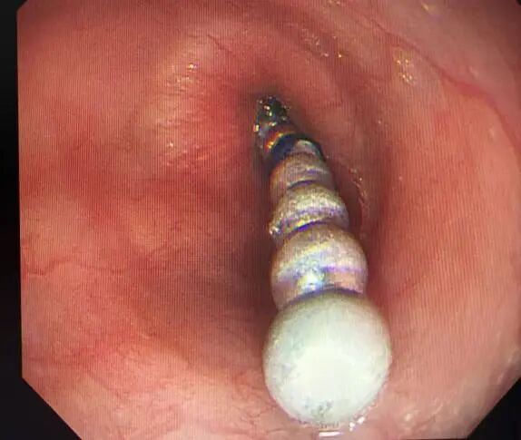 安徽3岁幼童紧急就医!医生:很危险,处理不当可危及生命 安徽3岁幼童紧急就医!医生:很危险,处理不当可危及生命