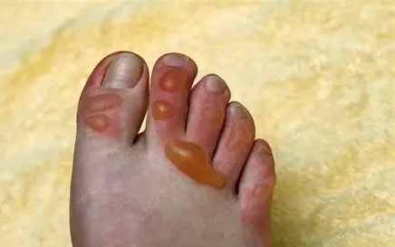 购物送的保温杯突然炸了!杭州一女子脚被二度烫伤,水泡密密麻麻…… 购物送的保温杯突然炸了!杭州一女子脚被二度烫伤,水泡密密麻麻……