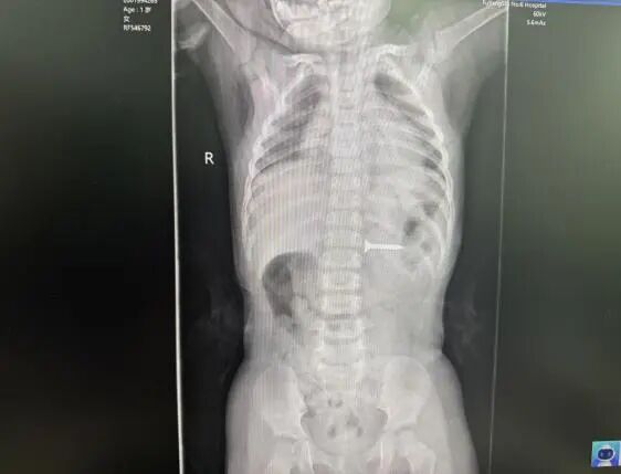 安徽3岁幼童紧急就医!医生:很危险,处理不当可危及生命 安徽3岁幼童紧急就医!医生:很危险,处理不当可危及生命